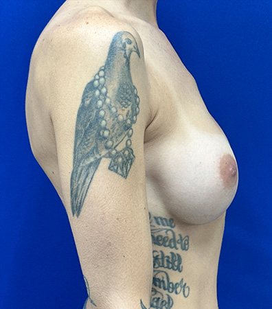 Augmentation Revision Before and After | Plastic Surgery Institute of Washington