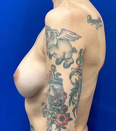 Augmentation Revision Before and After | Plastic Surgery Institute of Washington