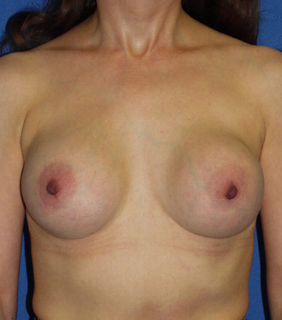 Augmentation Revision Before and After | Plastic Surgery Institute of Washington