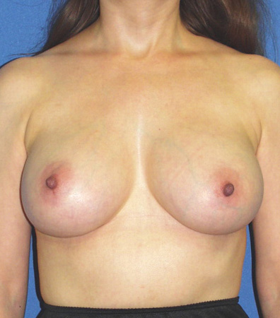 Augmentation Revision Before and After | Plastic Surgery Institute of Washington