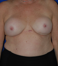 Augmentation Revision Before and After | Plastic Surgery Institute of Washington