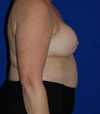 Augmentation Revision Before and After | Plastic Surgery Institute of Washington