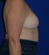Augmentation Revision Before and After | Plastic Surgery Institute of Washington