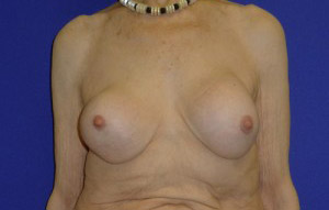 Augmentation Revision Before and After | Plastic Surgery Institute of Washington