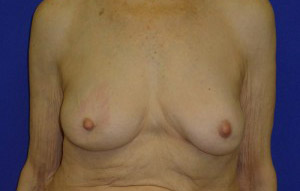 Augmentation Revision Before and After | Plastic Surgery Institute of Washington