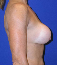 Augmentation Revision Before and After | Plastic Surgery Institute of Washington
