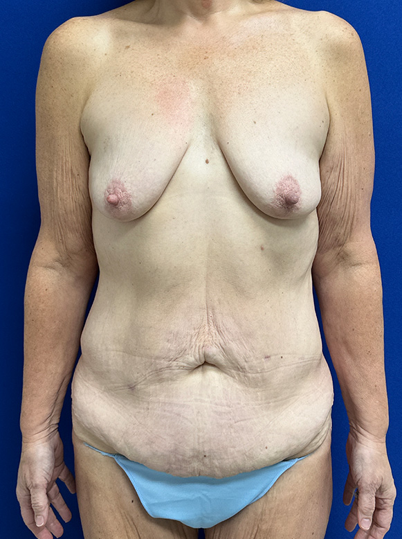 Extended Abdominoplasty Before and After | Plastic Surgery Institute of Washington