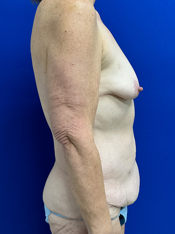 Extended Abdominoplasty Before and After | Plastic Surgery Institute of Washington