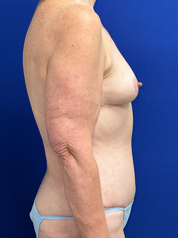 Extended Abdominoplasty Before and After | Plastic Surgery Institute of Washington