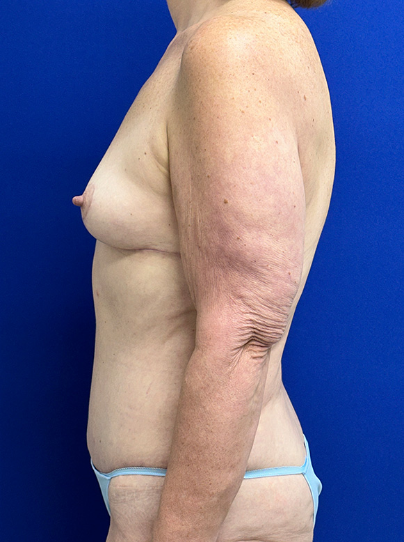 Extended Abdominoplasty Before and After | Plastic Surgery Institute of Washington