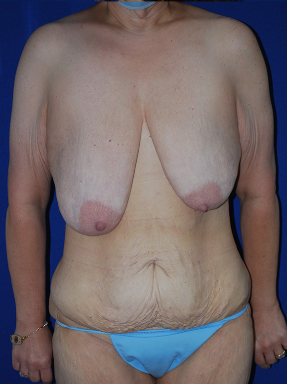 Extended Abdominoplasty Before and After | Plastic Surgery Institute of Washington