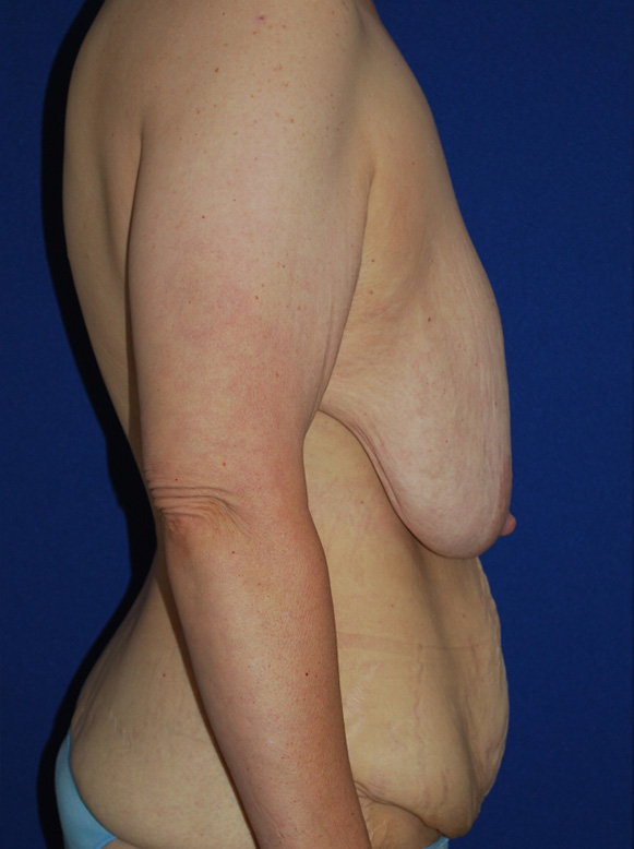 Extended Abdominoplasty Before and After | Plastic Surgery Institute of Washington