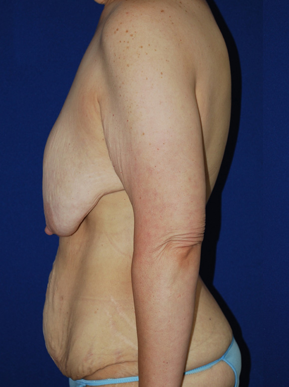 Extended Abdominoplasty Before and After | Plastic Surgery Institute of Washington