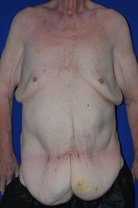 Extended Abdominoplasty Before and After | Plastic Surgery Institute of Washington