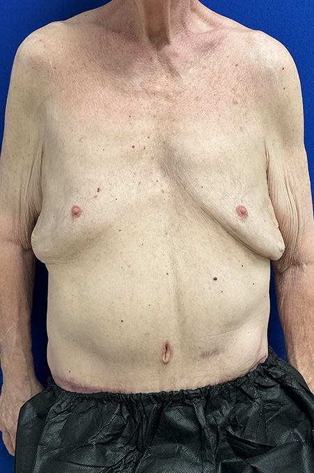 Extended Abdominoplasty Before and After | Plastic Surgery Institute of Washington