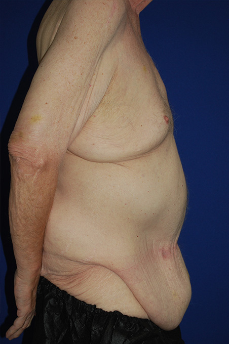 Extended Abdominoplasty Before and After | Plastic Surgery Institute of Washington