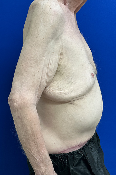 Extended Abdominoplasty Before and After | Plastic Surgery Institute of Washington