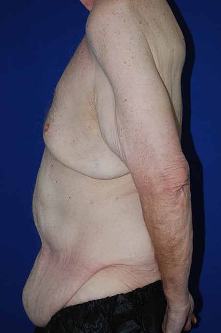 Extended Abdominoplasty Before and After | Plastic Surgery Institute of Washington