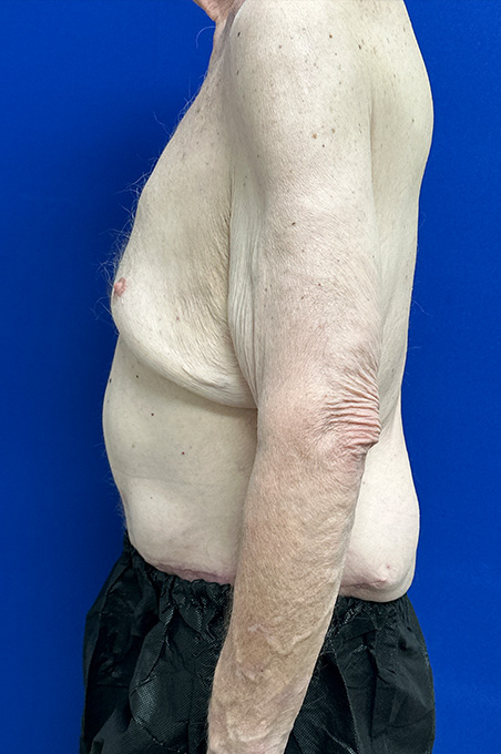 Extended Abdominoplasty Before and After | Plastic Surgery Institute of Washington
