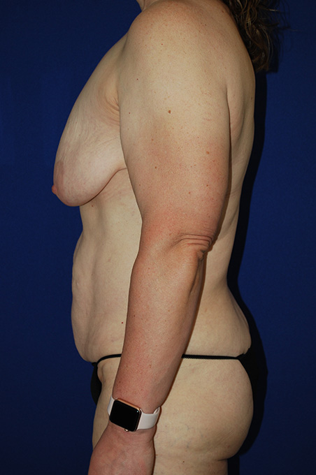 Extended Abdominoplasty Before and After | Plastic Surgery Institute of Washington