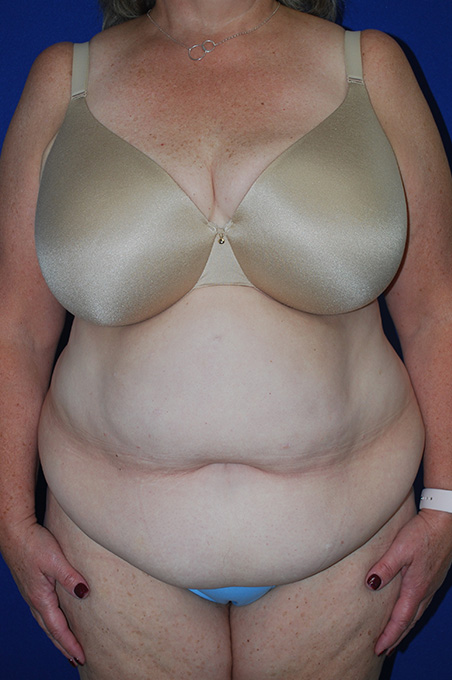 Extended Abdominoplasty Before and After | Plastic Surgery Institute of Washington