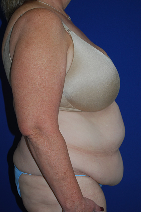 Extended Abdominoplasty Before and After | Plastic Surgery Institute of Washington