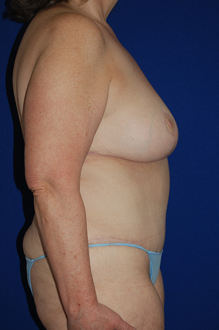 Extended Abdominoplasty Before and After | Plastic Surgery Institute of Washington