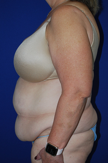 Extended Abdominoplasty Before and After | Plastic Surgery Institute of Washington