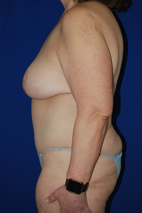 Extended Abdominoplasty Before and After | Plastic Surgery Institute of Washington
