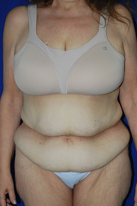 Extended Abdominoplasty Before and After | Plastic Surgery Institute of Washington