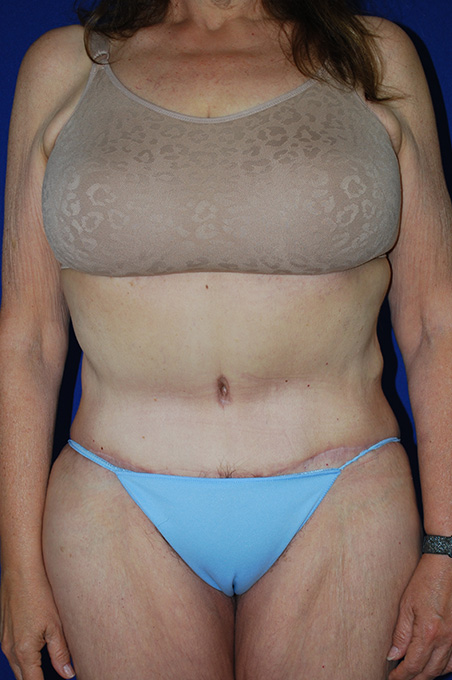 Extended Abdominoplasty Before and After | Plastic Surgery Institute of Washington