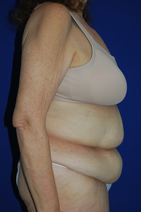 Extended Abdominoplasty Before and After | Plastic Surgery Institute of Washington