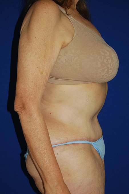 Extended Abdominoplasty Before and After | Plastic Surgery Institute of Washington