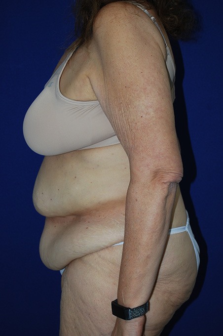 Extended Abdominoplasty Before and After | Plastic Surgery Institute of Washington
