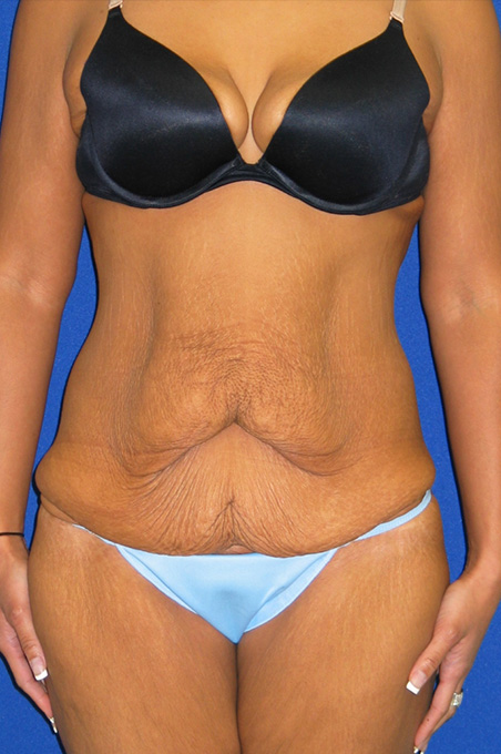 Extended Abdominoplasty Before and After | Plastic Surgery Institute of Washington