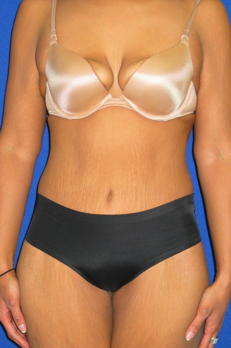 Extended Abdominoplasty Before and After | Plastic Surgery Institute of Washington