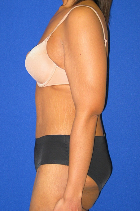 Extended Abdominoplasty Before and After | Plastic Surgery Institute of Washington