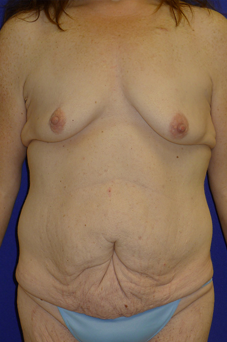 Extended Abdominoplasty Before and After | Plastic Surgery Institute of Washington