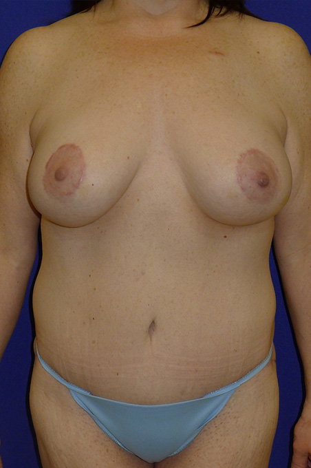 Extended Abdominoplasty Before and After | Plastic Surgery Institute of Washington