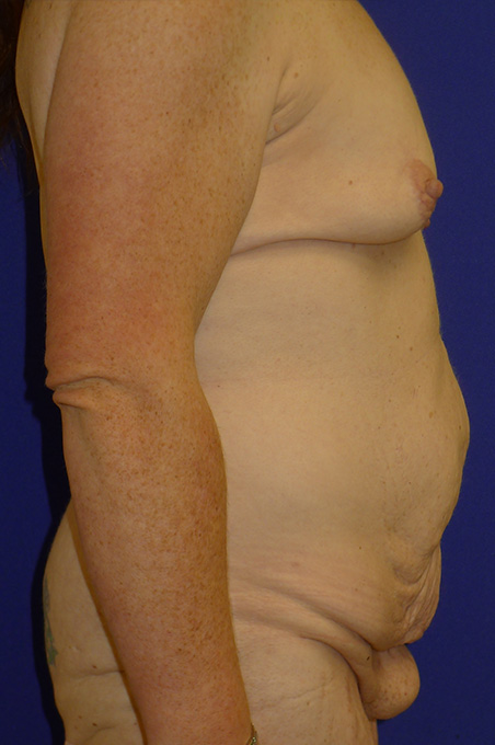 Extended Abdominoplasty Before and After | Plastic Surgery Institute of Washington