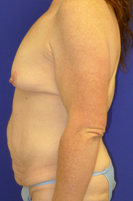 Extended Abdominoplasty Before and After | Plastic Surgery Institute of Washington