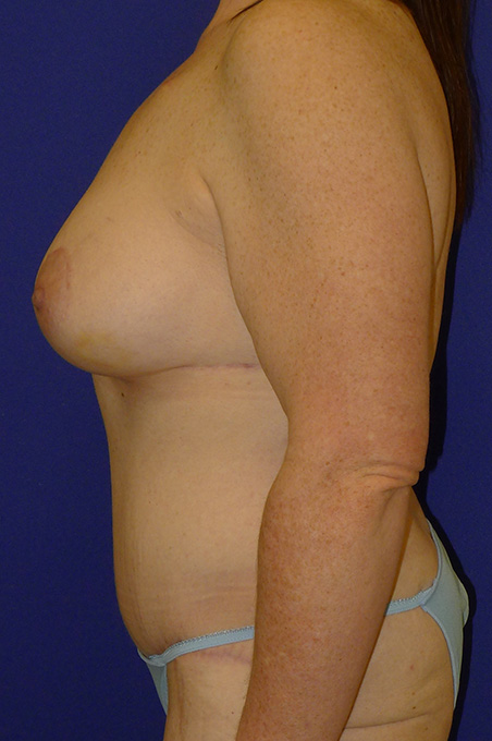Extended Abdominoplasty Before and After | Plastic Surgery Institute of Washington