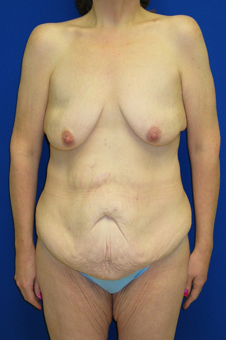 Extended Abdominoplasty Before and After | Plastic Surgery Institute of Washington