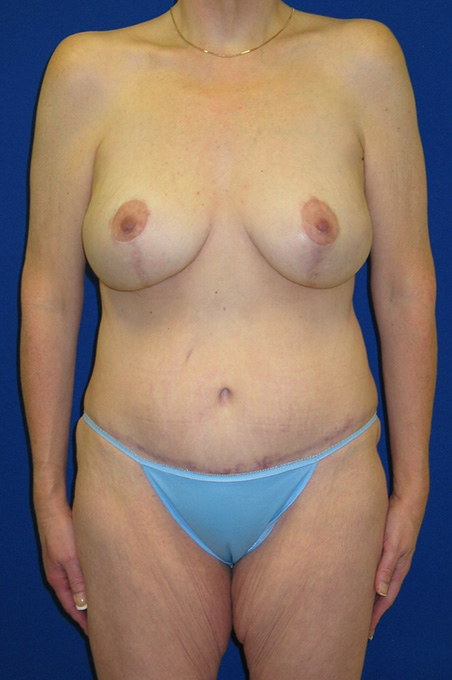 Extended Abdominoplasty Before and After | Plastic Surgery Institute of Washington