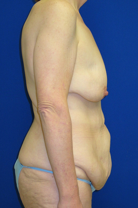 Extended Abdominoplasty Before and After | Plastic Surgery Institute of Washington