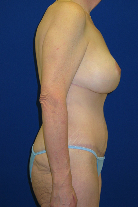 Extended Abdominoplasty Before and After | Plastic Surgery Institute of Washington