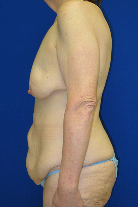Extended Abdominoplasty Before and After | Plastic Surgery Institute of Washington