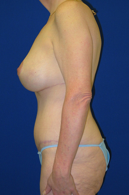 Extended Abdominoplasty Before and After | Plastic Surgery Institute of Washington