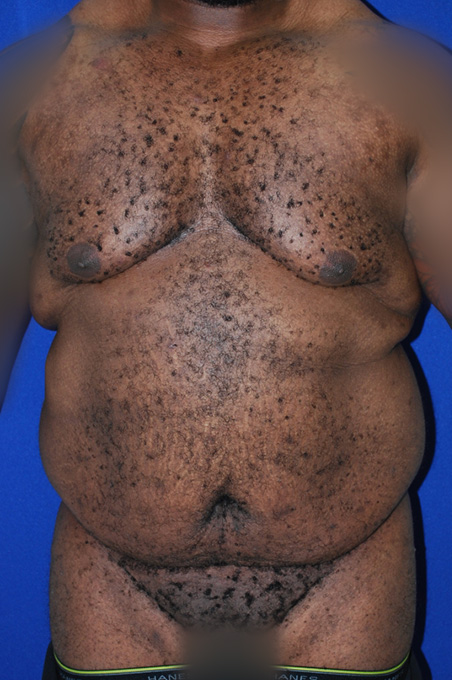 Extended Abdominoplasty Before and After | Plastic Surgery Institute of Washington
