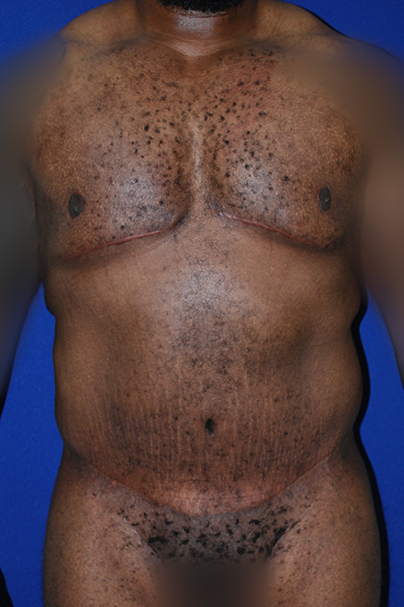 Extended Abdominoplasty Before and After | Plastic Surgery Institute of Washington